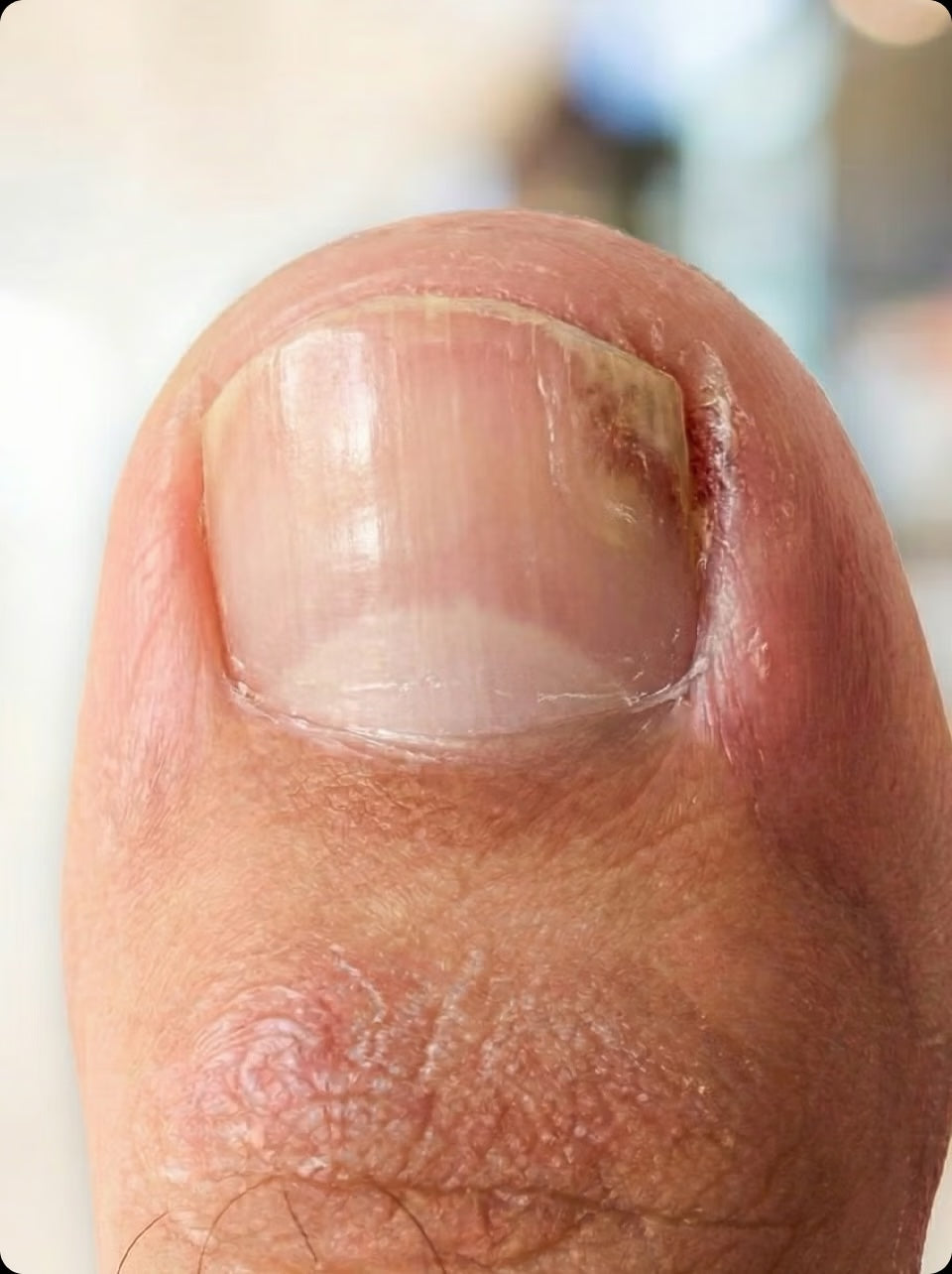 Nail affected by fungus