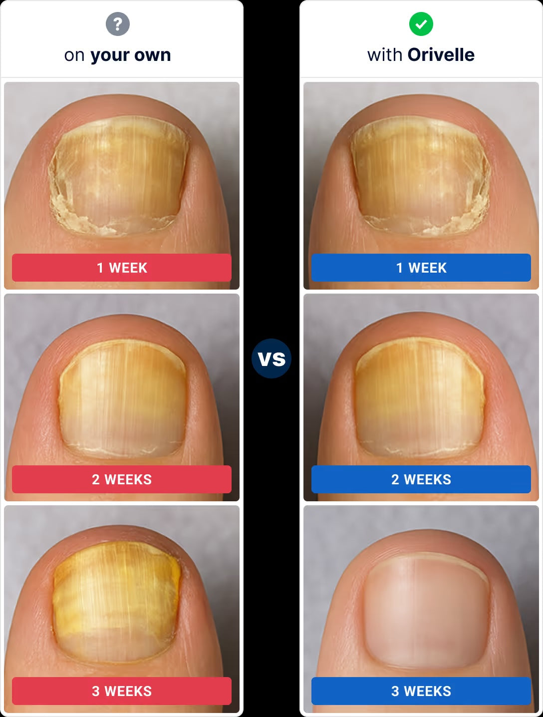 Nail appearance over time: on your own vs with Orivelle